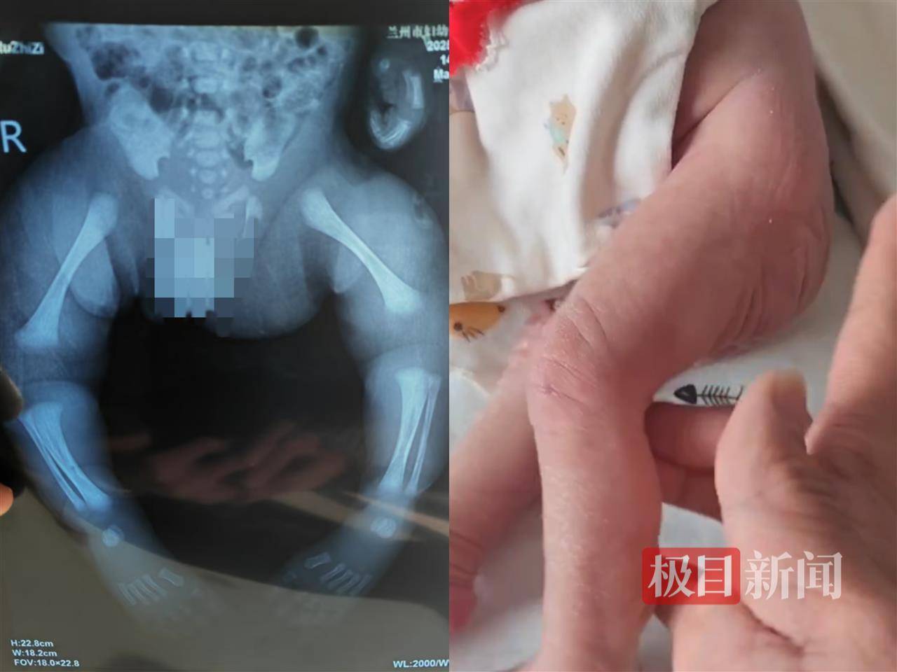 二胎出生查出先天性病症或落下残疾<strong></p>
<p>艾达币APP下载</strong>，残疾父母称医院产检漏检、未尽告知义务，医院及医调委回应