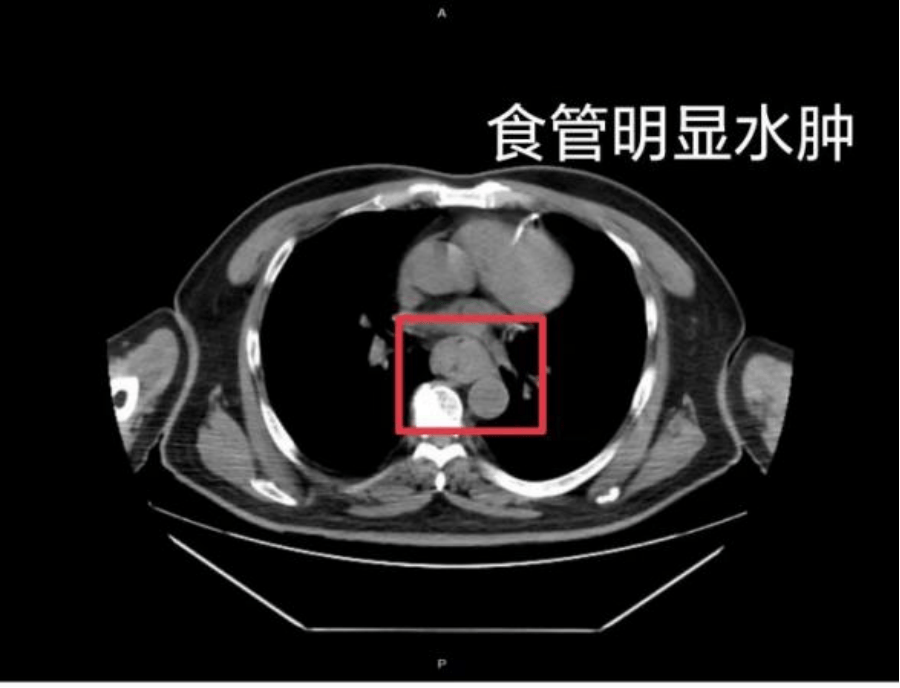 【家常话健康】一口热汤<strong></p>
<p>比特现金价格</strong>，差点要了幼童的命！不是所有东西都适合“趁热吃”