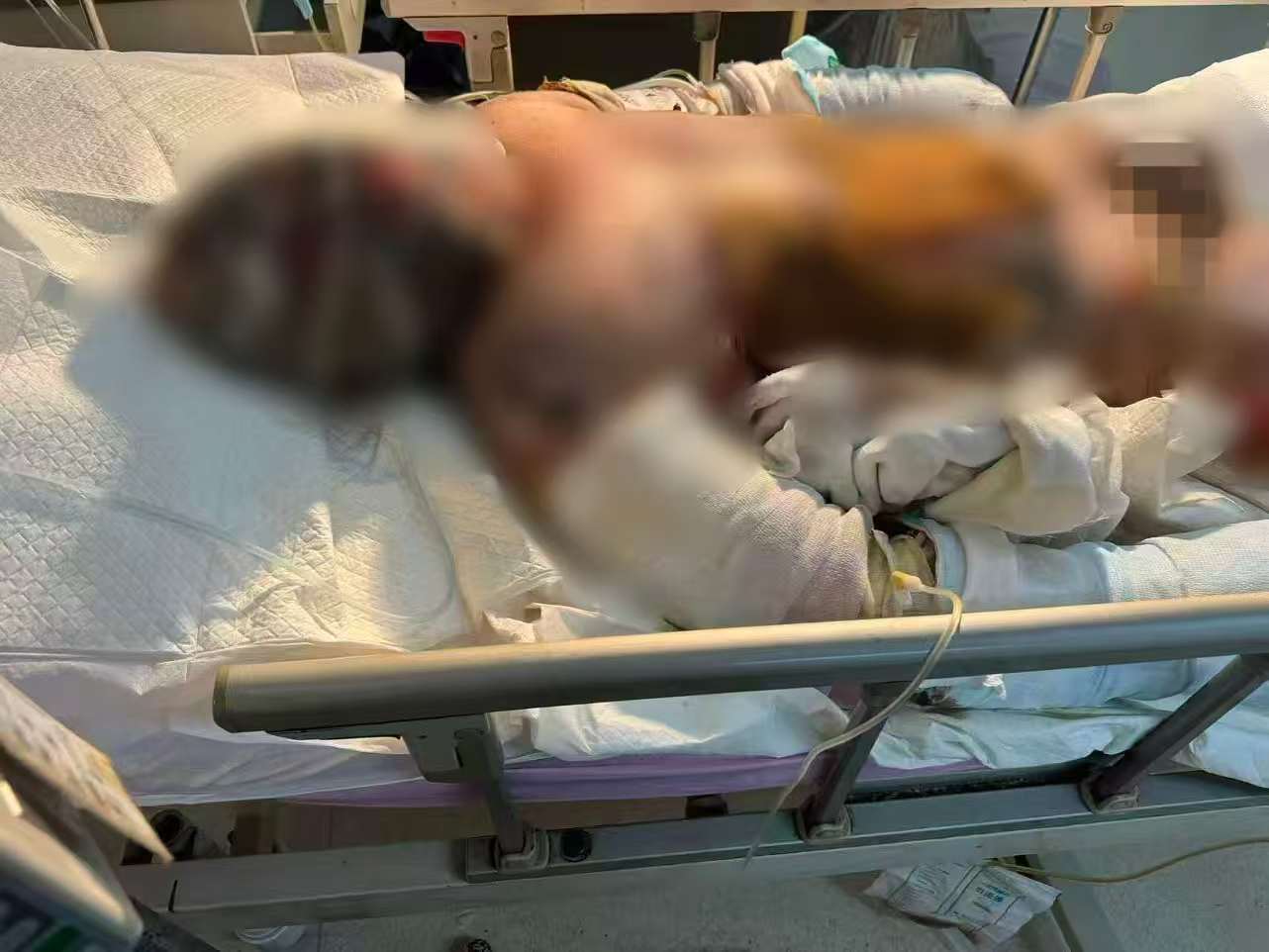 父子在哈尔滨一亲戚公司上班遇爆炸全身烧伤<strong></p>
<p>数字货币交易APP下载</strong>，治疗花费近百万公司拒赔偿？亲戚回应