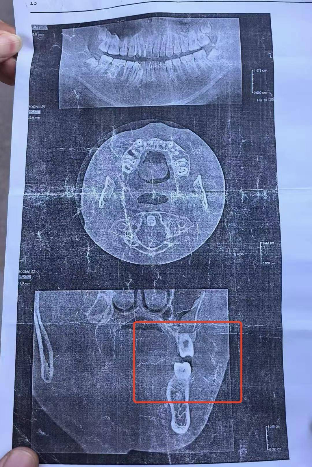 初三男生与体育老师发生冲突面部被打骨折<strong></p>
<p>老虎证券开户多少钱</strong>，校方：已开除涉事老师，正协商赔偿事宜