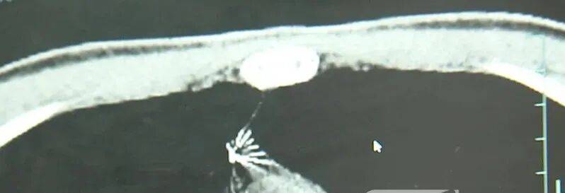 17岁小伙参军体检发现胸腔内有根5cm缝衣针<strong></p>
<p>平安证券交易行情</strong>，父母回忆或是1岁时扎入，取出时已锈迹斑斑