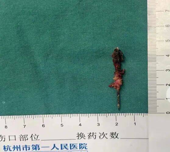 17岁小伙参军体检发现胸腔内有根5cm缝衣针<strong></p>
<p>平安证券交易行情</strong>，父母回忆或是1岁时扎入，取出时已锈迹斑斑